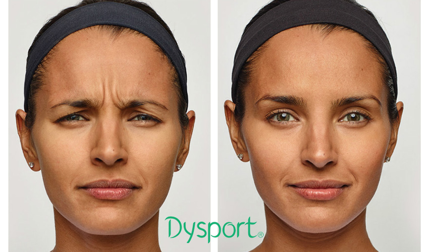 Dysport Botox Best Hair Restoration And Transplant In San Jose Bay Area And Milpitas